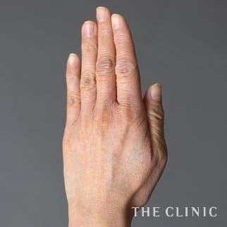 【THE CLINIC 症例画像】No.825_1_手のシワ_手の甲への脂肪注入(ハンドリバイブ)