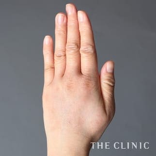 【THE CLINIC 症例画像】No.825_2_手のシワ_手の甲への脂肪注入(ハンドリバイブ)