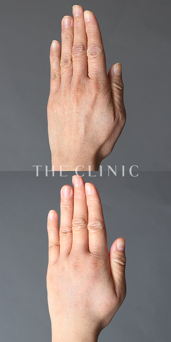 手のシワの手の甲への脂肪注入(ハンドリバイブ)（38歳女性）の術前・術後写真
