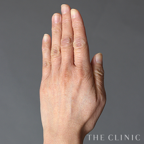 手のシワの手の甲への脂肪注入(ハンドリバイブ)（38歳女性）の術前写真