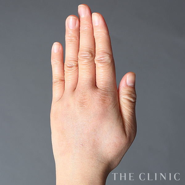 手のシワの手の甲への脂肪注入(ハンドリバイブ)（38歳女性）の術後写真