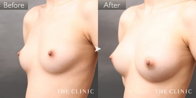 ボリュームアップ(女性/20歳)