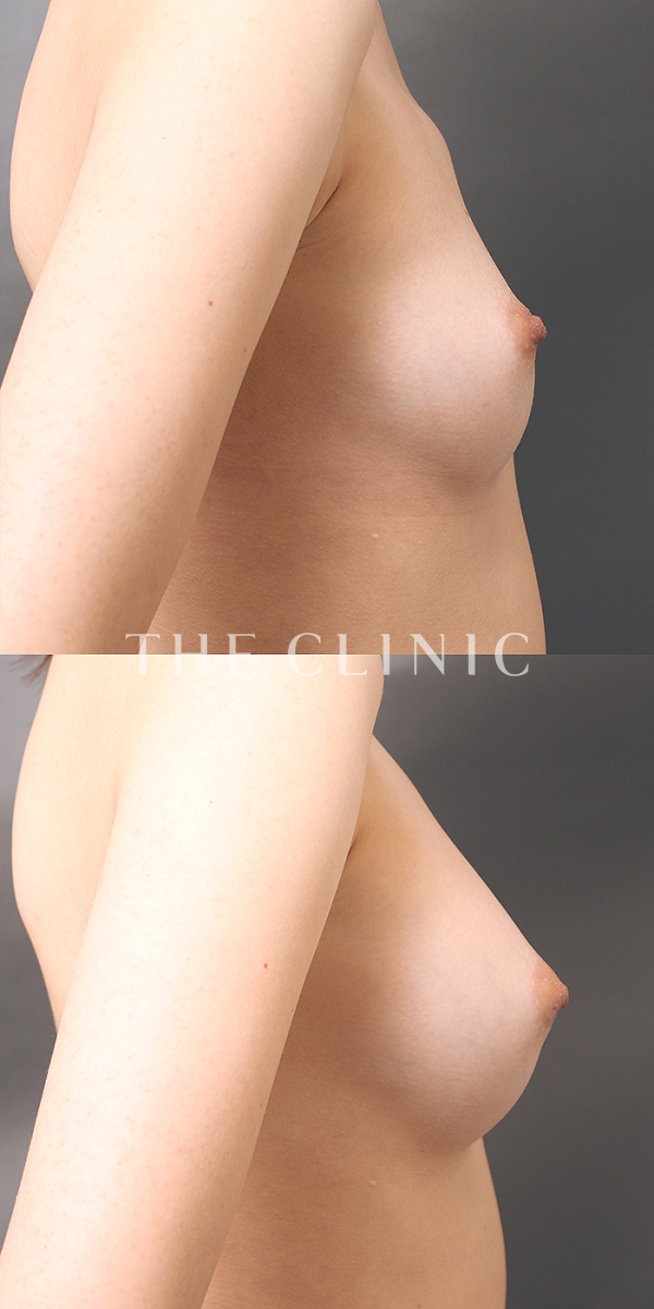 ボリュームアップのコンデンスリッチ豊胸（20歳女性）の術前・術後写真