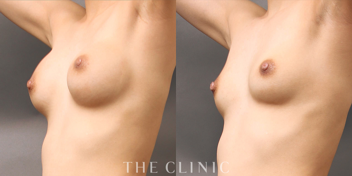 豊胸シリコンバッグ除去の術前／術後