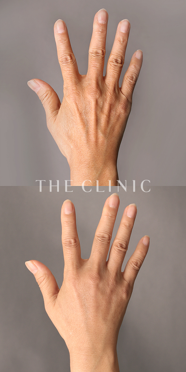 手のシワの手の甲への脂肪注入(ハンドリバイブ)（54歳女性）の術前・術後写真