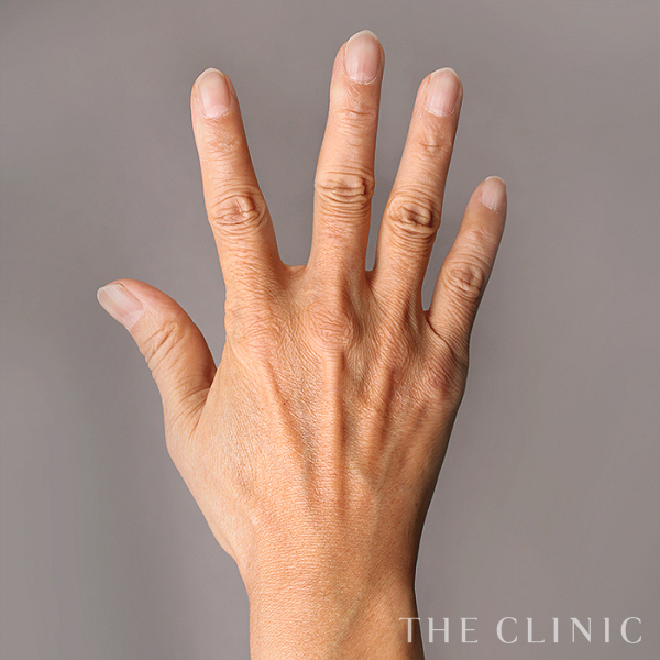 手のシワの手の甲への脂肪注入(ハンドリバイブ)（54歳女性）の術前写真