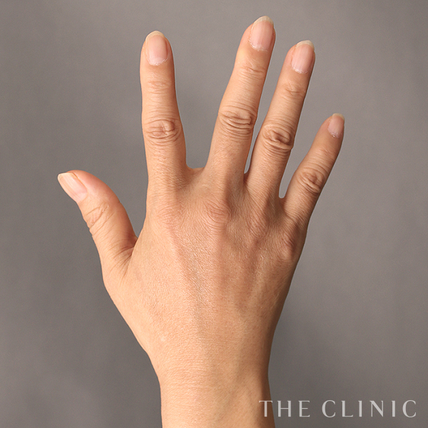 手のシワの手の甲への脂肪注入(ハンドリバイブ)（54歳女性）の術後写真