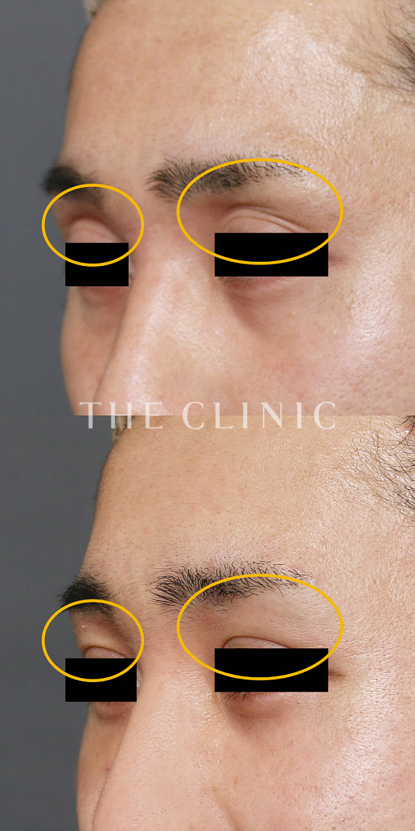 目の上のくぼみのマイクロCRF注入(顔の脂肪注入)（30歳男性）の術前・術後写真