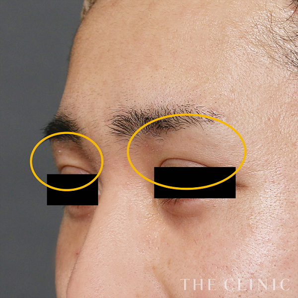 目の上のくぼみのマイクロCRF注入(顔の脂肪注入)（30歳男性）の術後写真