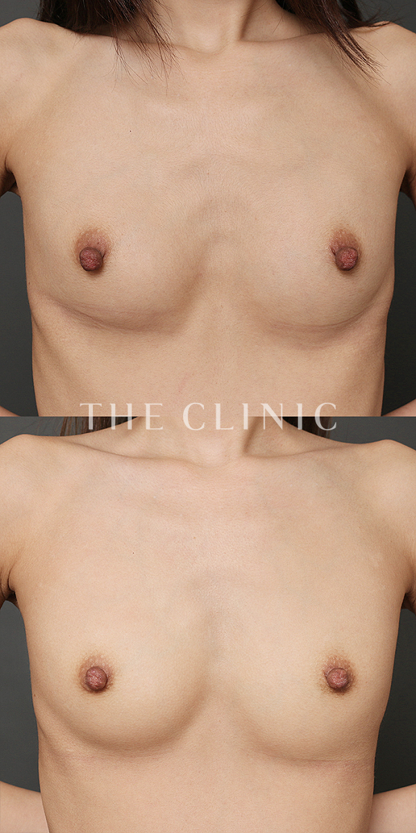 ボリュームアップのコンデンスリッチ豊胸（32歳女性）の術前・術後写真