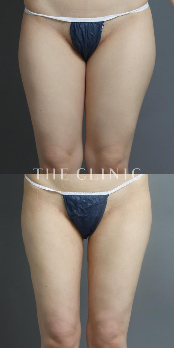 太もものベイザー脂肪吸引（25歳女性）の術前・術後写真