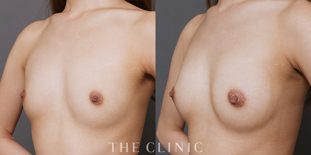 コンデンスビブラ豊胸の術前/術後