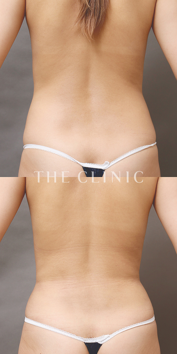 腰・ウエストのベイザー脂肪吸引（26歳女性）の術前・術後写真