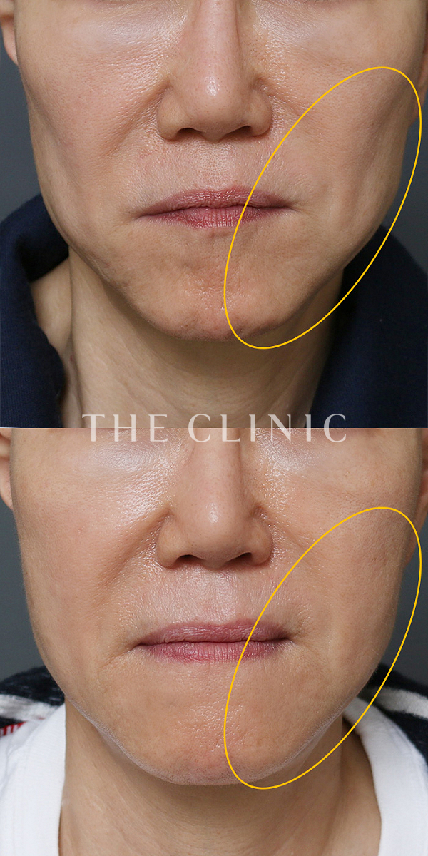 こけた頬のコンデンスリッチフェイス(顔の脂肪注入)（56歳女性）の術前・術後写真