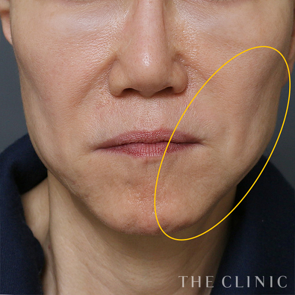 こけた頬のコンデンスリッチフェイス(顔の脂肪注入)（56歳女性）の術前写真