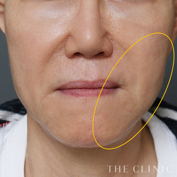 こけた頬のコンデンスリッチフェイス(顔の脂肪注入)（56歳女性）の術後写真