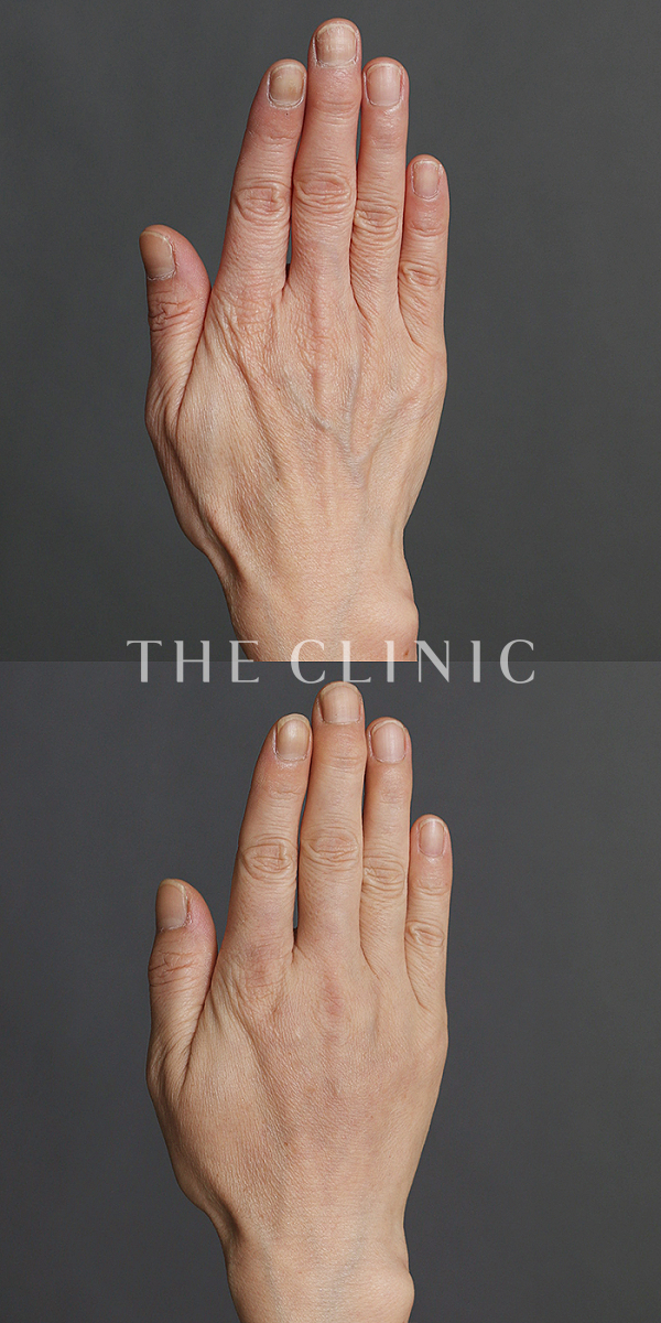 手のシワの手の甲への脂肪注入(ハンドリバイブ)（56歳女性）の術前・術後写真