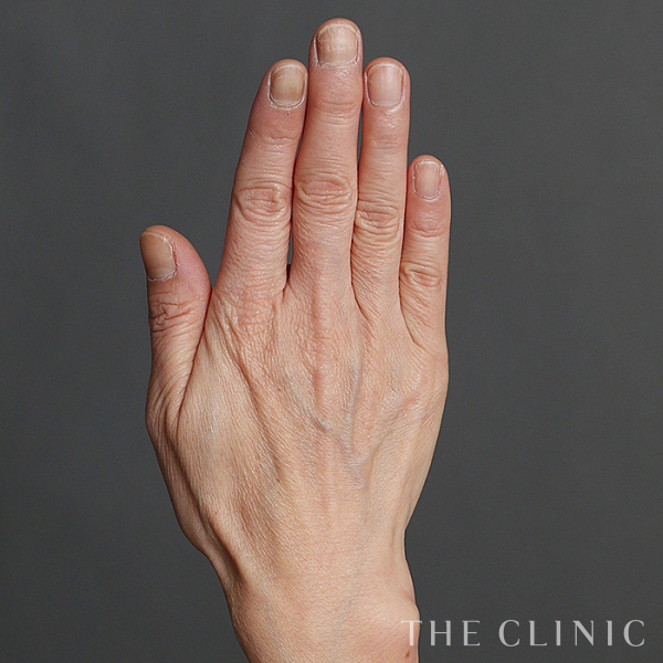 手のシワの手の甲への脂肪注入(ハンドリバイブ)（56歳女性）の術前写真