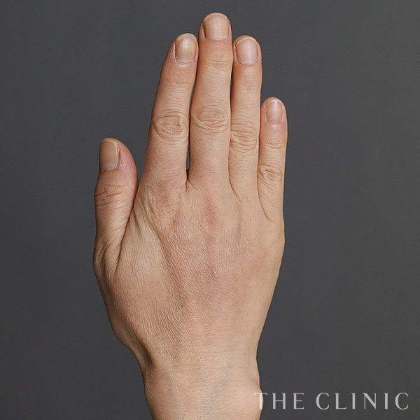 手のシワの手の甲への脂肪注入(ハンドリバイブ)（56歳女性）の術後写真