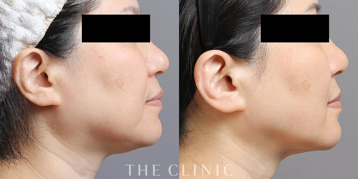 ベイザー脂肪吸引の術前/術後