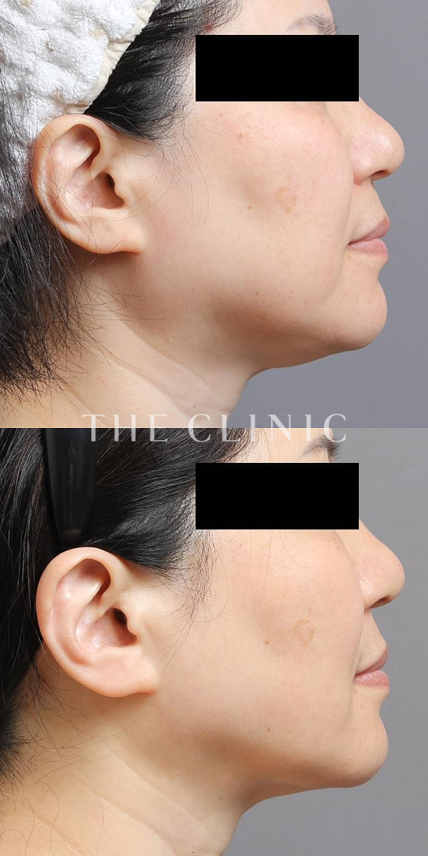 頰／顎のベイザー脂肪吸引（56歳女性）の術前・術後写真