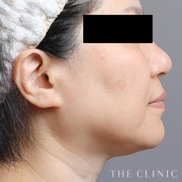 頰／顎のベイザー脂肪吸引（56歳女性）の術前写真