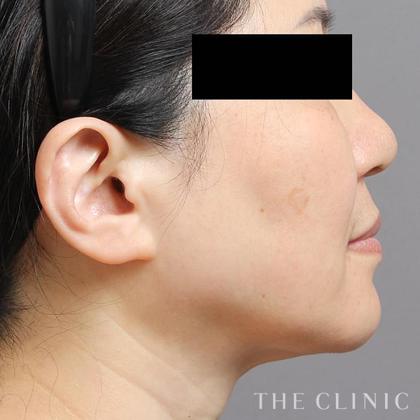 頰／顎のベイザー脂肪吸引（56歳女性）の術後写真