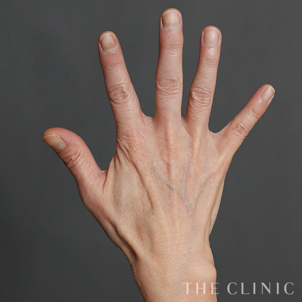 手のシワの手の甲への脂肪注入(ハンドリバイブ)（56歳女性）の術前写真