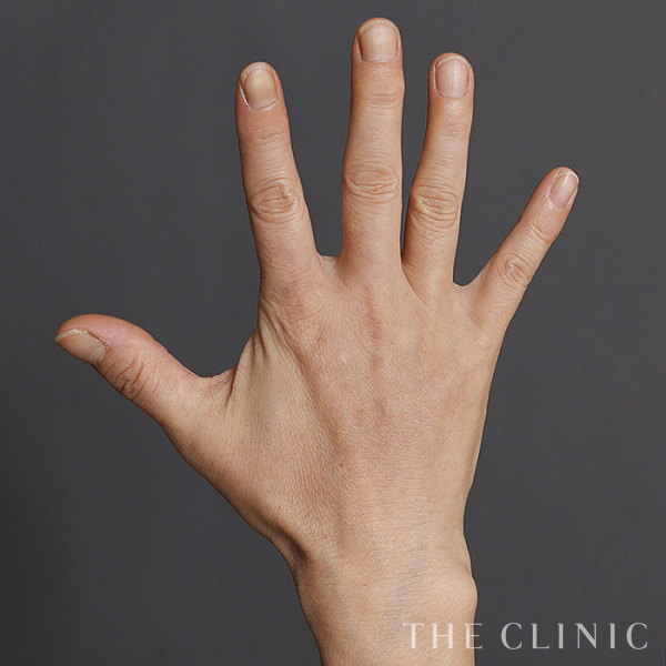 手のシワの手の甲への脂肪注入(ハンドリバイブ)（56歳女性）の術後写真