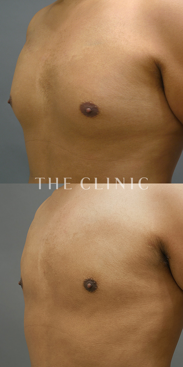 胸部のデザインのベイザー脂肪吸引（27歳男性）の術前・術後写真