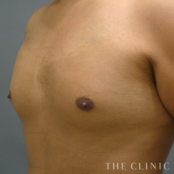 胸部のデザインのベイザー脂肪吸引（27歳男性）の術前写真