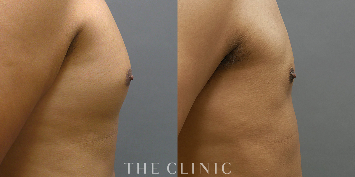 360脂肪吸引®の術前／術後