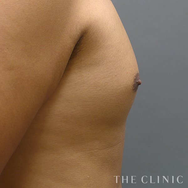 女性化乳房の360脂肪吸引®（27歳男性）の術前写真