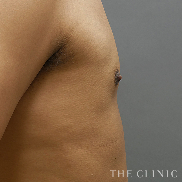 女性化乳房の360脂肪吸引®（27歳男性）の術後写真