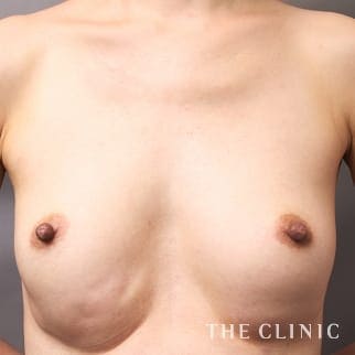 【THE CLINIC 症例画像】No.875_1_ボリュームアップ_豊胸ヒアルロン酸除去(執刀医:村田 八千穂)