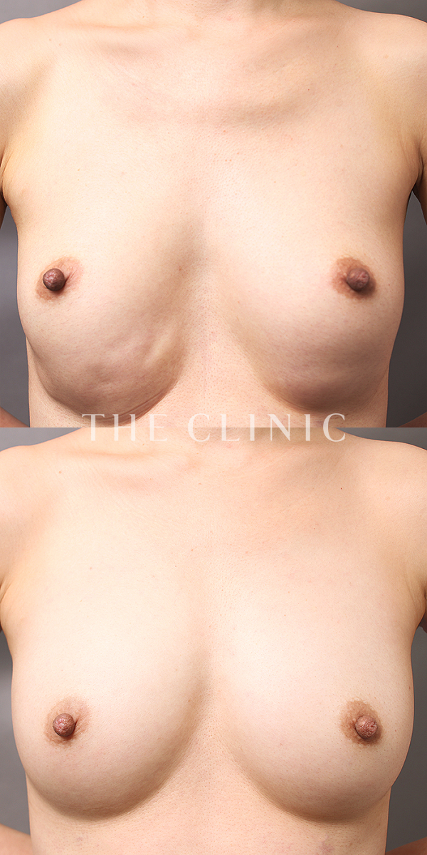 ボリュームアップの豊胸ヒアルロン酸除去（37歳女性）の術前・術後写真