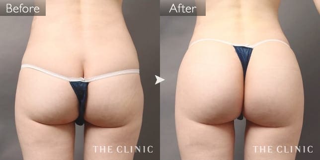 ヒップアップ(女性/35歳)