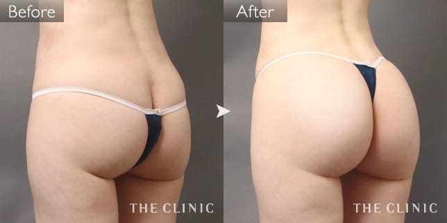 脂肪吸引 ヒップアップ 症例写真