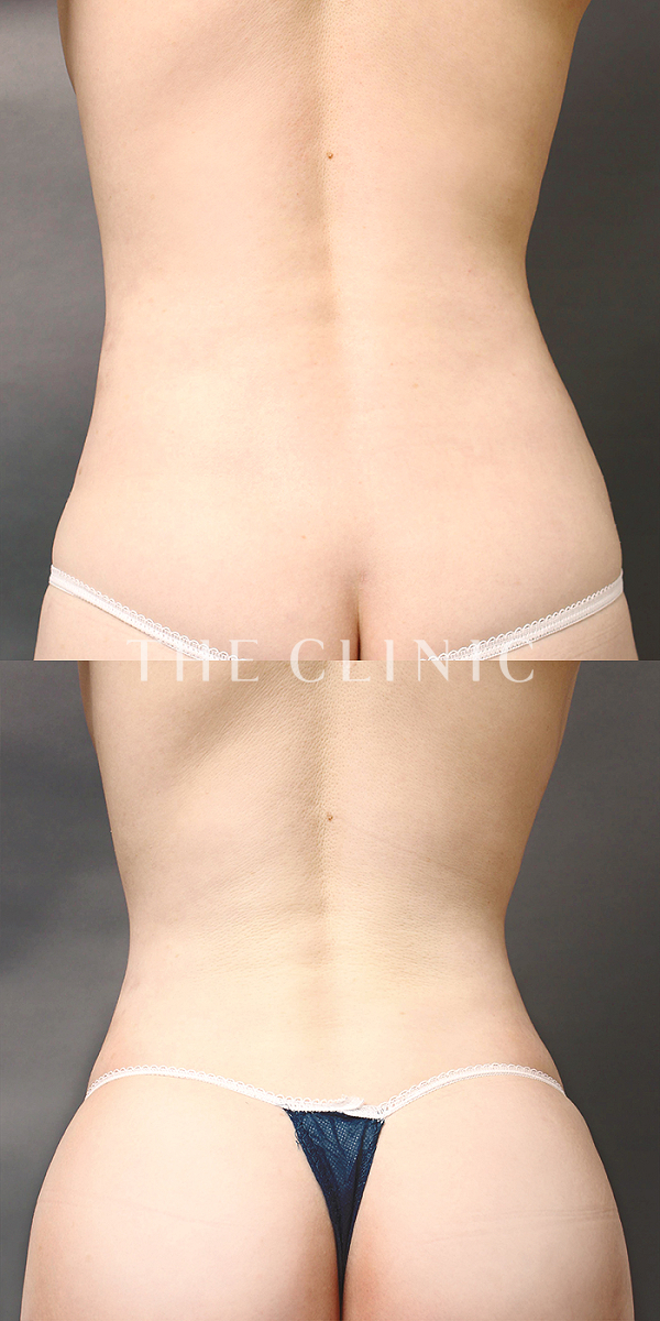 腰・ウエストのベイザー脂肪吸引（35歳女性）の術前・術後写真