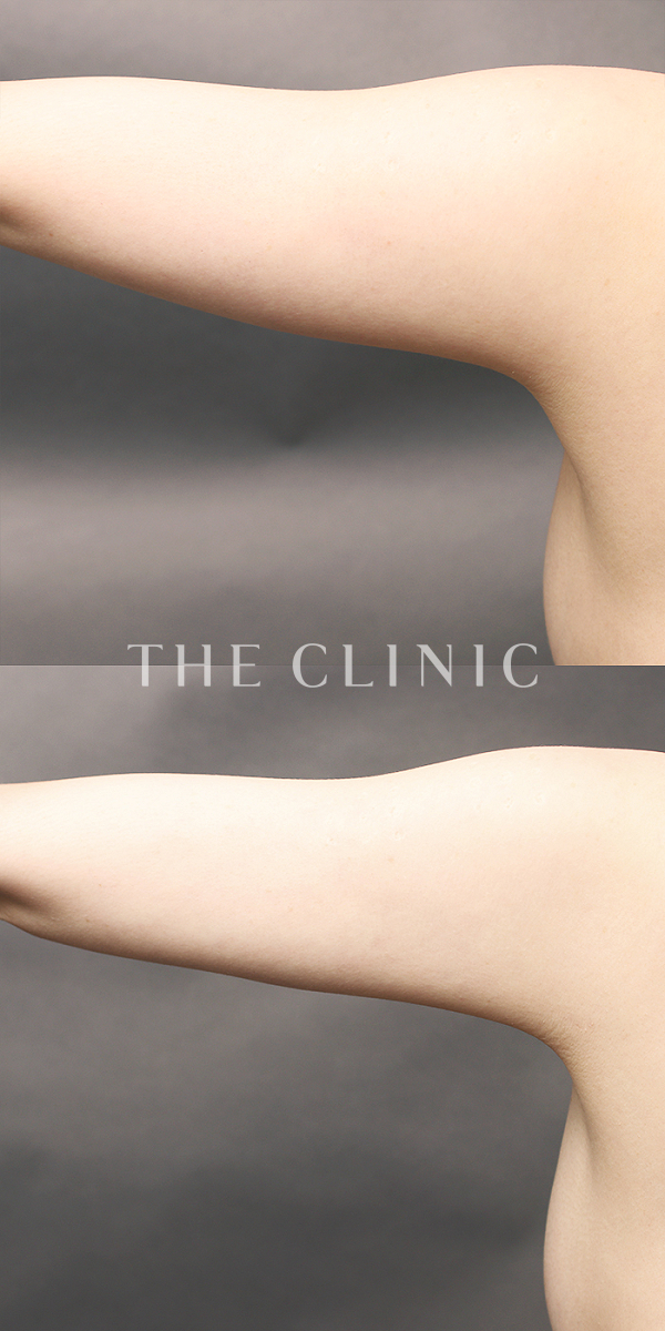 二の腕のベイザー脂肪吸引（35歳女性）の術前・術後写真