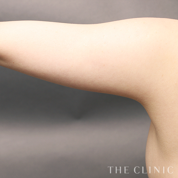 二の腕のベイザー脂肪吸引（35歳女性）の術前写真