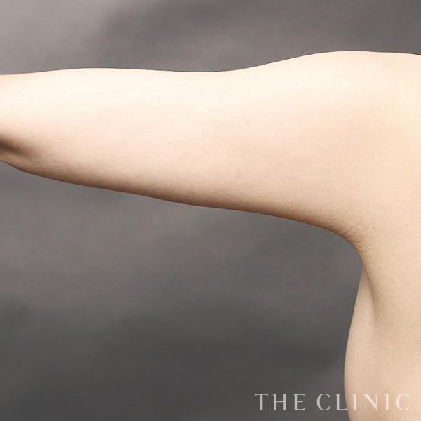二の腕のベイザー脂肪吸引（35歳女性）の術後写真