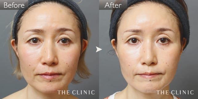 目の下のクマ(女性/51歳)