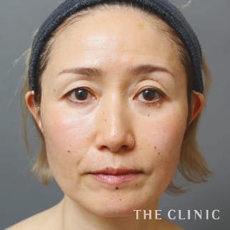 【THE CLINIC 症例画像】No.891_1_目の下のクマ_マイクロCRF注入(顔の脂肪注入)