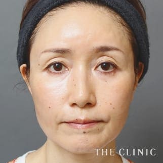 【THE CLINIC 症例画像】No.891_2_目の下のクマ_マイクロCRF注入(顔の脂肪注入)
