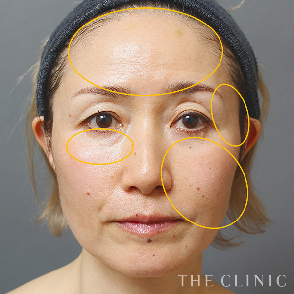 目の下のクマ・こめかみ・こけた頬・おでこ(額)のくぼみのマイクロCRF注入(顔の脂肪注入)（53歳女性）の術前写真