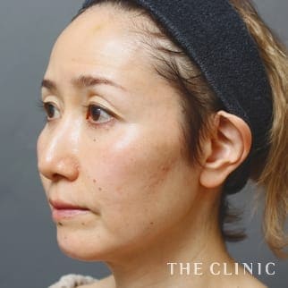 額のシワ／目の下のクマ／こめかみ／こけた頬のSRF注入(顔の脂肪注入)のモニター（50代）術前症例画像