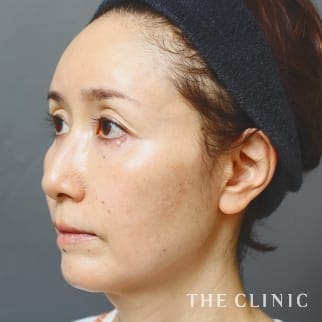 【THE CLINIC 症例画像】No.892_2_額のシワ_SRF注入(顔の脂肪注入)