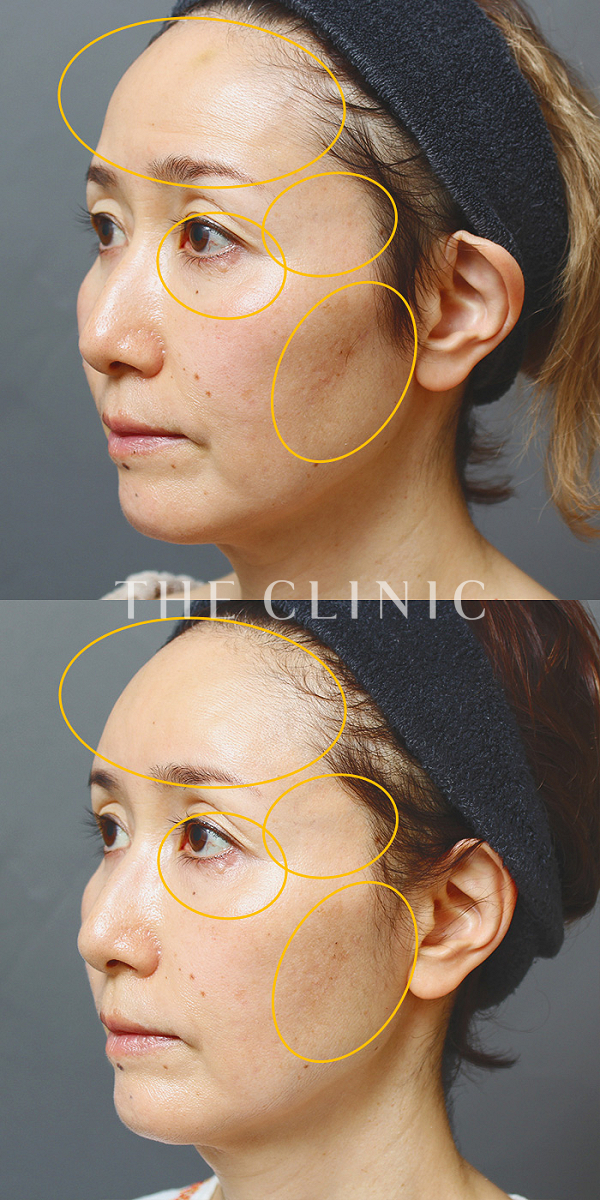 額のシワ・目の下のクマ・こめかみ・こけた頬のSRF注入(顔の脂肪注入)（53歳女性）の術前・術後写真