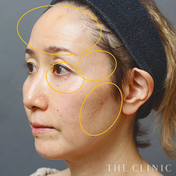 額のシワ・目の下のクマ・こめかみ・こけた頬のSRF注入(顔の脂肪注入)（53歳女性）の術前写真